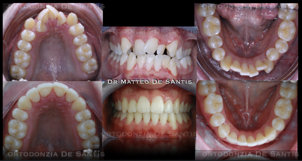 trattamento ortodontico di allineamento dentale con estrazioni di denti definitivi