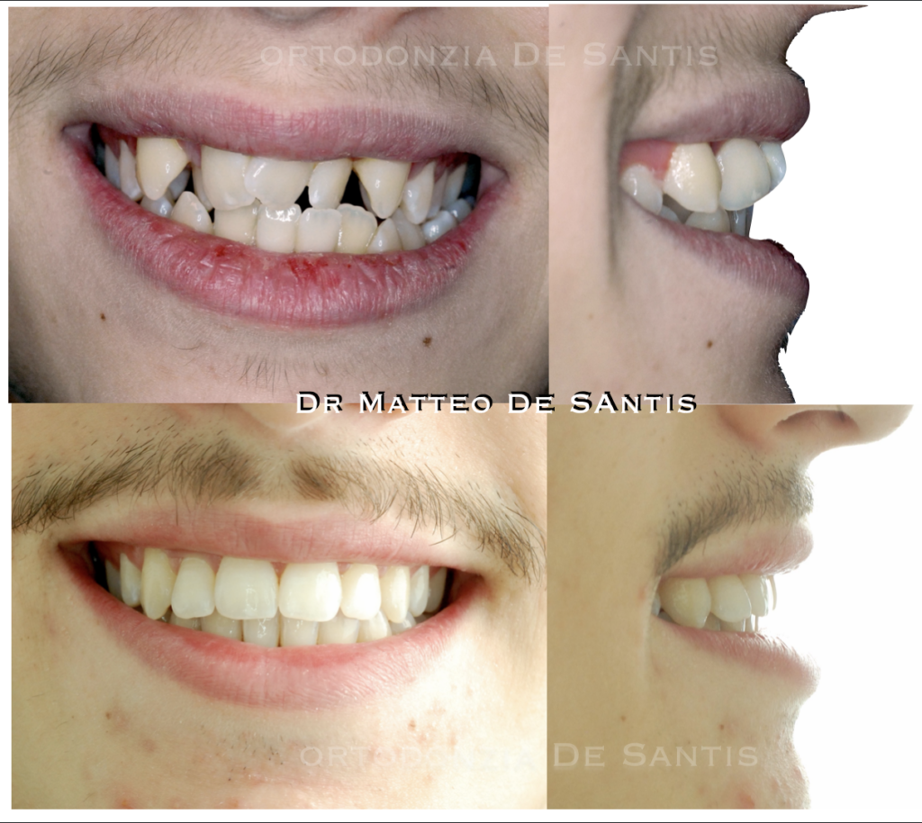 trattamento ortodontico di allineamento dentale con estrazioni di denti definitivi