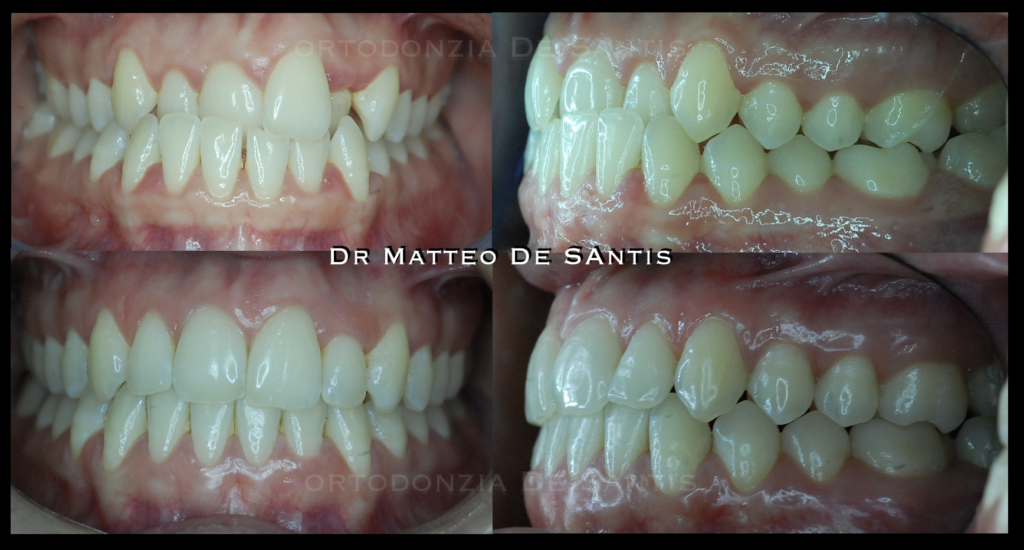 morso crociato anteriore. denti storti. morso inverso. affollamento dentario
